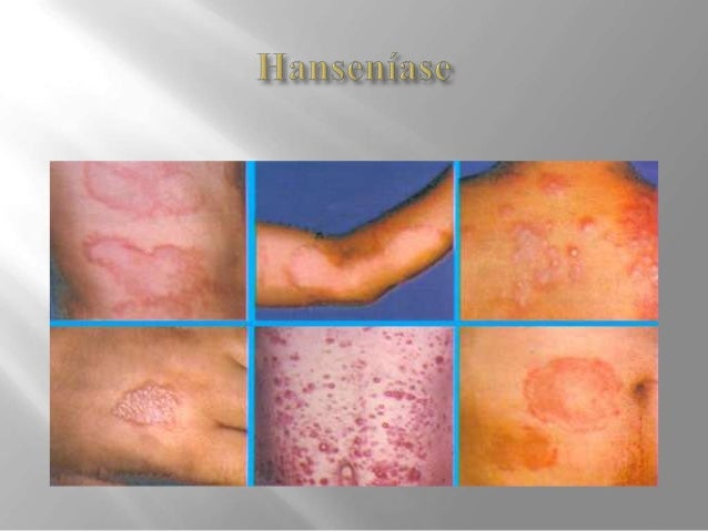 Gonorréia e hanseníase Gonorréia e hanseníase