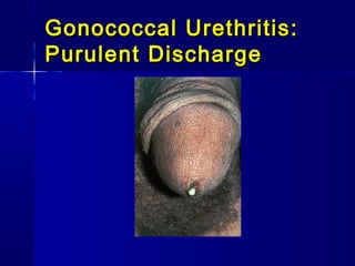 Gonococcal Urethritis:
Purulent Discharge

 
