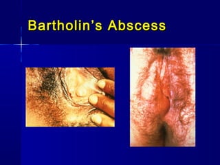 Bartholin’s Abscess

 