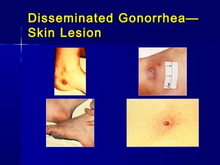 Disseminated Gonorrhea—
Skin Lesion

 