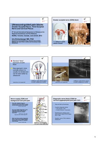 1
Ultrasound-guided pain blocks
Greater Occipital Nerve, Third Occipital
Nerve and Cervical Plexus
9th A l I t ti l S i f Ult d f9th Annual International Symposium of Ultrasound for
Regional Anaesthesia and Pain Medicine
ISURA, Toronto, Canada, June 22-25, 2012
Urs Eichenberger MD, PhD
Department of Anaesthesiology, Intensive Care and Pain
Medicine, St. Anna Clinic, Lucerne and University of Bern,
Switzerland
Greater occipital nerve (GON) block
1 = obliquus capitis
inferior muscle
1
1
Standard “blind”
approach of GON
block
New approach: more
centrally where it is
1 Obliquus capitis inferior muscle
2 Greater occipital nerve (GON)
usually not divided and
can be seen better by
ultrasound
Greher M et al., Br J Anaesth 2010
Our new approach:
more centrally where
1 Obliquus capitis inferior muscle
2 Greater occipital nerve (GON)
it is usually not
divided and can be
seen better by
ultrasound
Greher M et al., Br J Anaesth 2010
1
Nerve supply (TON) and
background C2/3 joint pain
> Pain after whiplash injury is
common and in up to 50% of cases
cervical facet joints are the reason
Lord et al, Spine 1996
> The only reliable diagnostic is the
diagnostic block of the nerves
innervating the joint (medial
branches)
Barnsley et al., Pain 1993
Siegenthaler et al., Anesth Analg 2010
> After two times positive diagnostic
block - there is an evidence based
and effective therapy: RF ablation
of the nerves
Lord et al., NEJM 1996
TON innervates the joint
C 2/3 and a small skin area
Diagnostic nerve block (TON) for
cervical zygapophysial joint pain C2/3
> Easy and fast by fluoroscopy
> 2 positive diagnostic blocks
— VAS reduction > 90%
— Duration lidocaine < bupivacainep
> Radiofrequency ablation gives
same result in about 70% of cases
up to 1 year
> Question: nerve (TON) visible by
ultrasound?
 