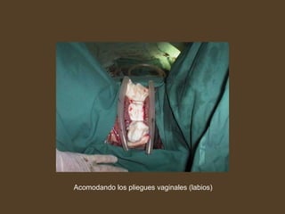 Acomodando los pliegues vaginales (labios)