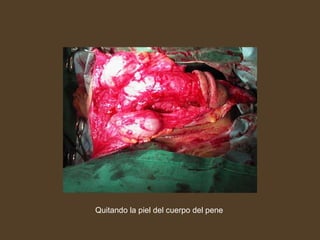 Quitando la piel del cuerpo del pene
