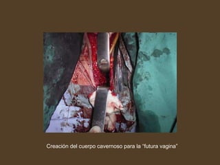 Creación del cuerpo cavernoso para la “futura vagina”