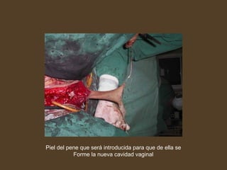 Piel del pene que será introducida para que de ella se Forme la nueva cavidad vaginal