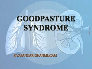 GOODPASTURE
SYNDROME
SIVASANGARI SHANMUGAM
 