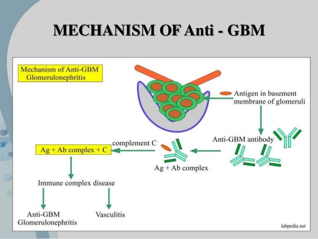 Goodpasture Syntrome