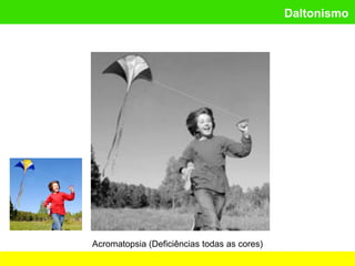 Daltonismo
Acromatopsia (Deficiências todas as cores)
 