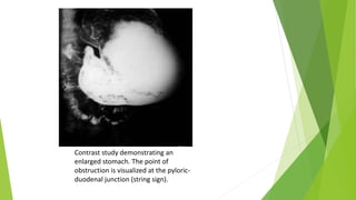 Contrast study demonstrating an
enlarged stomach. The point of
obstruction is visualized at the pyloric-
duodenal junction (string sign).
 
