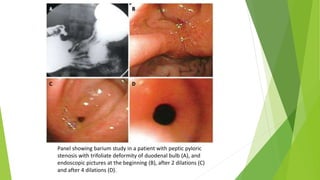 Panel showing barium study in a patient with peptic pyloric
stenosis with trifoliate deformity of duodenal bulb (A), and
endoscopic pictures at the beginning (B), after 2 dilations (C)
and after 4 dilations (D).
 