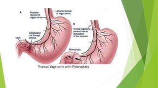 Truncal Vagatomy with Pyloroplasy
 