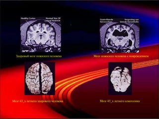 Темный шоколад и мозг




  Здоровый мозг пожилого человека                 Мозг пожилого человека с повреждением




Мозг 43_х летнего здорового человека                   Мозг 43_х летнего алкоголика
 