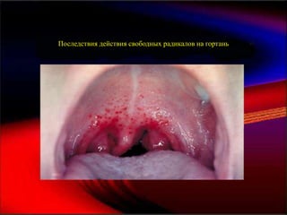 Последствия действия свободных радикалов на гортань
 