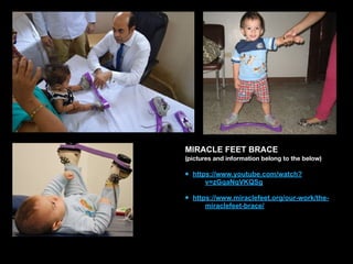 MIRACLE FEET BRACE
(pictures and information belong to the below)
• https://www.youtube.com/watch?
v=zGqaNqVKQSg 
• https://www.miraclefeet.org/our-work/the-
miraclefeet-brace/
 