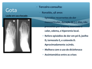 ∗ Terceira consulta:
∗ Ronaldo, 48 anos
∗ Episódios recorrentes de dor
monoarticular, duração de 5-7 dias, não
precedido por trauma, associado a
calor, edema, e hiperemia local.
∗ Refere episódios de dor em pé D, joelho
D, tornozelo E, e cotovelo D.
Aproximadamente 2x/mês.
∗ Melhora com o uso de diclofenaco
∗ Assintomático entre as crises
Gota
Lesão em saca bocado
 
