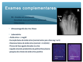 Exames complementares
∗ RX – Erosões em saca-bocado
- Densidade óssea peri-lesional aumentada
- Cistos ósseos
∗ Ultrassonografia dos rins: litíase
∗ Laboratório:
– Ácido úrico > 7 mg/dl
- Excreção baixa de ácido úrico (normal entre 300 e 800 mg / 24 h)
- Clearence baixo de ácido úrico (normal > 6 ml/min)
- Provas de fase aguda elevadas na crise
- Líquido sinovial: predomínio de polimorfonucleares
- pesquisa de cristais de ácido úrico positiva
Monourato de
sódio
Pirofosfato de
cálcio
 