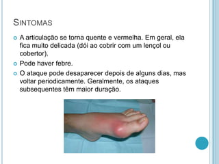 SINTOMAS
 A articulação se torna quente e vermelha. Em geral, ela
fica muito delicada (dói ao cobrir com um lençol ou
cobertor).
 Pode haver febre.
 O ataque pode desaparecer depois de alguns dias, mas
voltar periodicamente. Geralmente, os ataques
subsequentes têm maior duração.
 