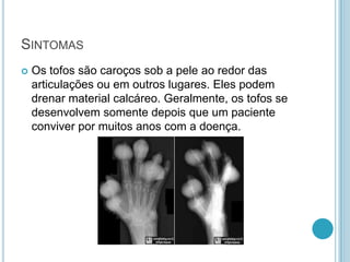 SINTOMAS
 Os tofos são caroços sob a pele ao redor das
articulações ou em outros lugares. Eles podem
drenar material calcáreo. Geralmente, os tofos se
desenvolvem somente depois que um paciente
conviver por muitos anos com a doença.
 