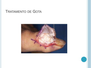 TRATAMENTO DE GOTA
 