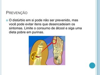 PREVENÇÃO
 O distúrbio em si pode não ser prevenido, mas
você pode evitar itens que desencadeiam os
sintomas. Limite o consumo de álcool e siga uma
dieta pobre em purinas.
 