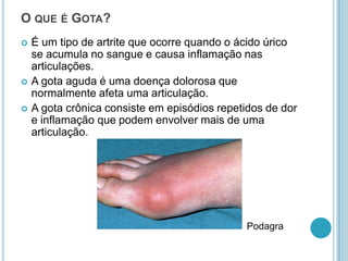 O QUE É GOTA?
 É um tipo de artrite que ocorre quando o ácido úrico
se acumula no sangue e causa inflamação nas
articulações.
 A gota aguda é uma doença dolorosa que
normalmente afeta uma articulação.
 A gota crônica consiste em episódios repetidos de dor
e inflamação que podem envolver mais de uma
articulação.
Podagra
 