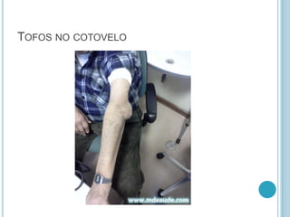 TOFOS NO COTOVELO
 