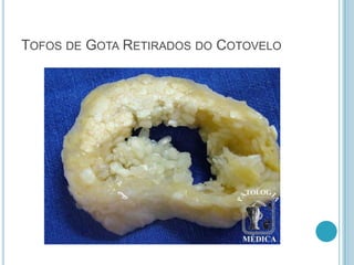 TOFOS DE GOTA RETIRADOS DO COTOVELO
 