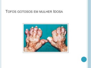 TOFOS GOTOSOS EM MULHER IDOSA
 