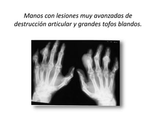 Manos con lesiones muy avanzadas de
destrucción articular y grandes tofos blandos.
 