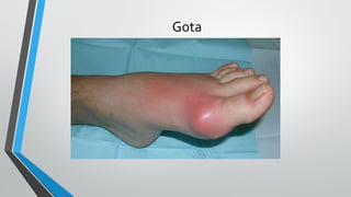 Gota
 