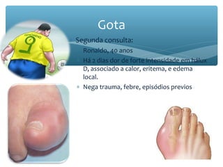 ∗ Segunda consulta:
∗ Ronaldo, 40 anos
∗ Há 2 dias dor de forte intensidade em hálux
D, associado a calor, eritema, e edema
local.
∗ Nega trauma, febre, episódios previos
Gota
 