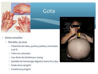 ∗ Sexta consulta:
∗ Ronaldo, 56 anos
∗ Poliartrite de mãos, punhos, joelhos, tornozelos
e pé D
∗ Tofos em cotovelos
∗ Uso diario de diclofenaco 150mg
∗ Episódio de hemorragia digestiva baixa há 3 dias
∗ Ácido úrico:13mg/ml
∗ Creatinina:3,2mg/ml
Gota
 