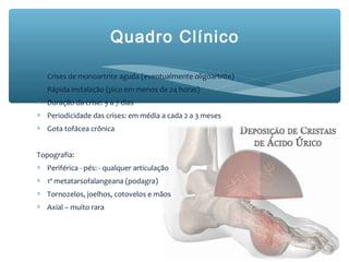 Quadro Clínico
∗ Crises de monoartrite aguda (eventualmente oligoartrite)
∗ Rápida instalação (pico em menos de 24 horas)
∗ Duração da crise: 3 a 7 dias
∗ Periodicidade das crises: em média a cada 2 a 3 meses
∗ Gota tofácea crônica
Topografia:
∗ Periférica - pés: - qualquer articulação
∗ 1ª metatarsofalangeana (podagra)
∗ Tornozelos, joelhos, cotovelos e mãos
∗ Axial – muito rara
 