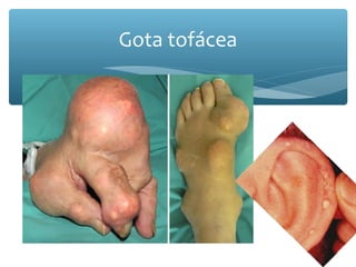 Gota tofácea
 