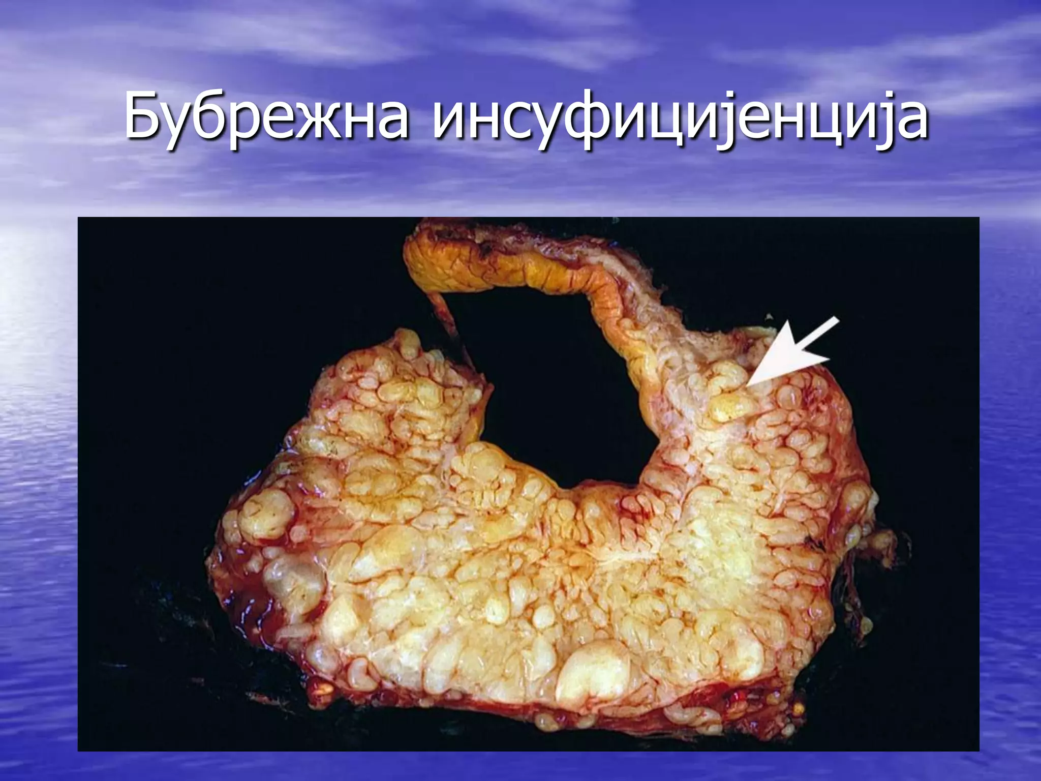 Бубрежна инсуфицијенција
 