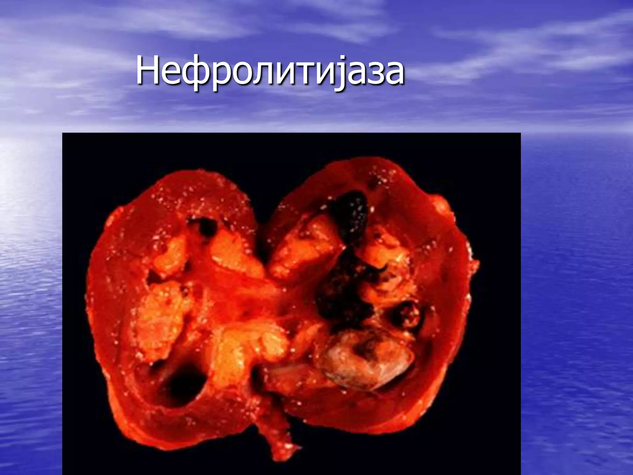 Нефролитијаза
 