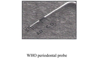 WHO periodontal probe
 
