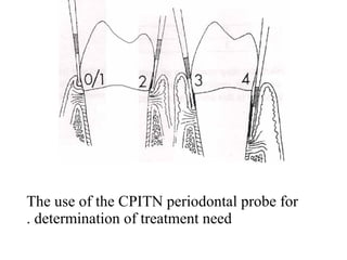 The use of the CPITN periodontal probe for
determination of treatment need.
 