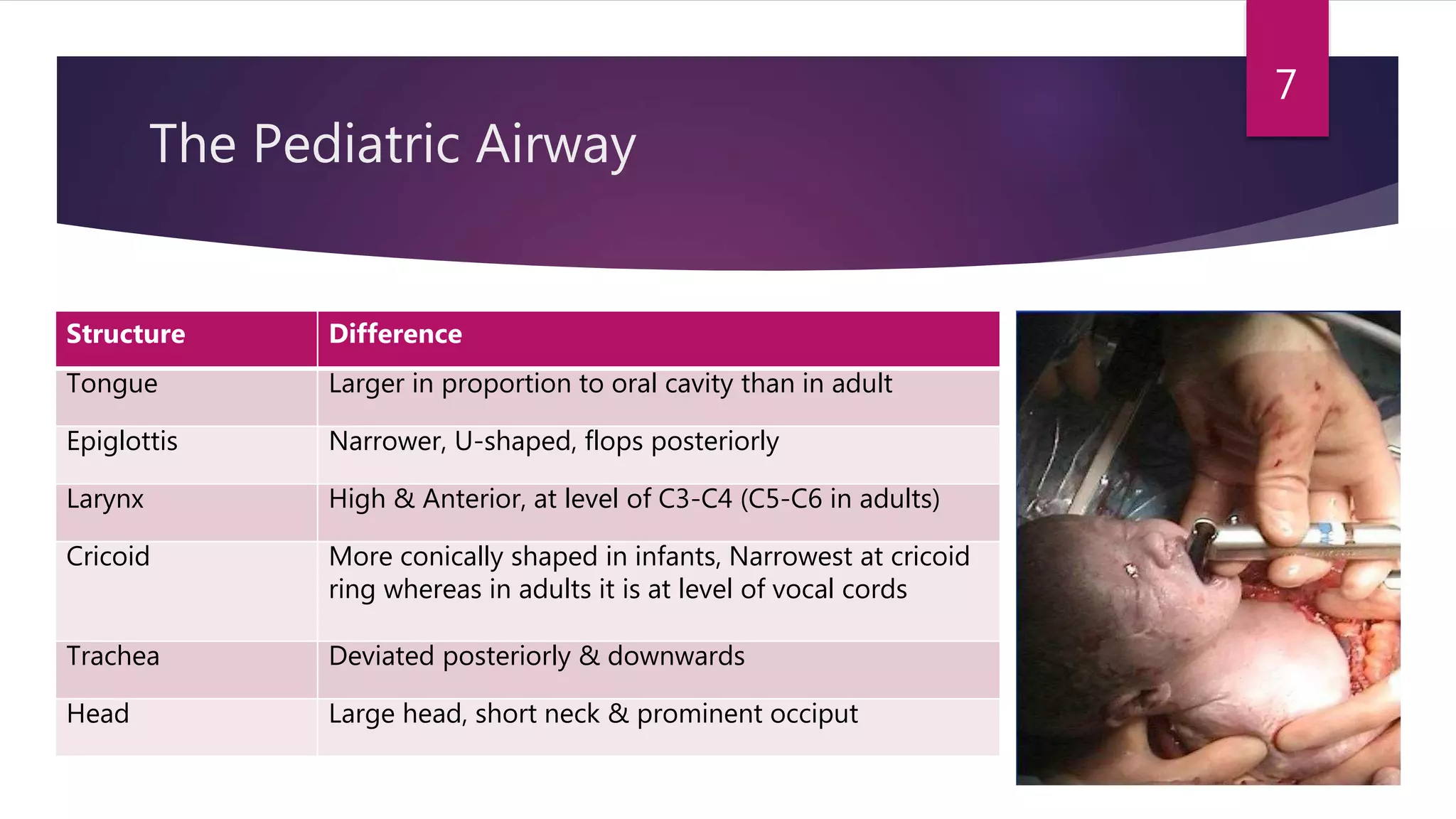 The Pediatric Airway
Structure Difference
Tongue Larger in proportion to oral cavity than in adult
Epiglottis Narrower, U-shaped, flops posteriorly
Larynx High & Anterior, at level of C3-C4 (C5-C6 in adults)
Cricoid More conically shaped in infants, Narrowest at cricoid
ring whereas in adults it is at level of vocal cords
Trachea Deviated posteriorly & downwards
Head Large head, short neck & prominent occiput
7