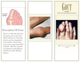GOUT
                                (HYPERURICEMIA)




Description Of Gout:
 Gout is a disorder that has
 too many uric acid in the
 blood and tissue. Crystals
 of uric acid are deposited
 in the joints, where they
 can cause a type of painful
                                † KIRSTEN CROSSON ¢
 arthritis. Also the crystals
 can deposit in the Kidney
 which can make Kidney
 Stones.
 