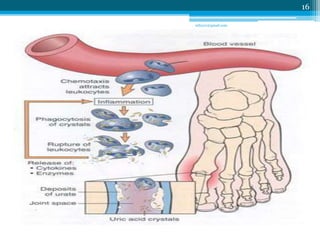 Gout | PPTX