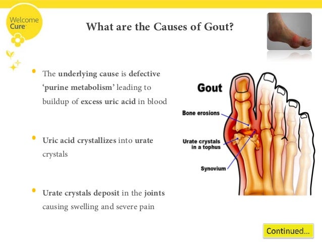 Disable Gout before It Disables You with Homeopathy!