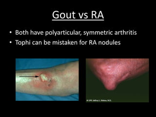 Gout Slide 31