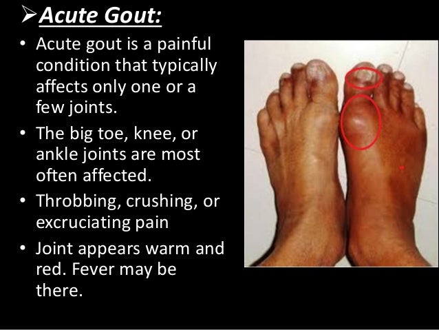 Ankle Gout | Ankle Diseases - Arthritis Foundation