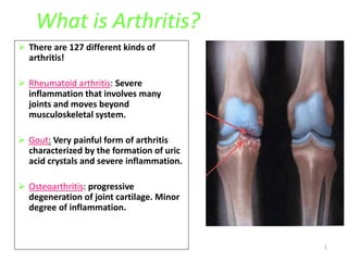 1
What is Arthritis?
 There are 127 different kinds of
arthritis!
 Rheumatoid arthritis: Severe
inflammation that involves many
joints and moves beyond
musculoskeletal system.
 Gout: Very painful form of arthritis
characterized by the formation of uric
acid crystals and severe inflammation.
 Osteoarthritis: progressive
degeneration of joint cartilage. Minor
degree of inflammation.
 