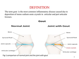 Gout Racgp Gout | PPTX
