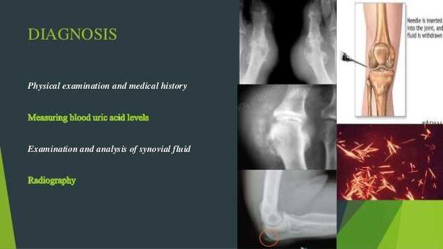 Gout(inflammatory joint disease)