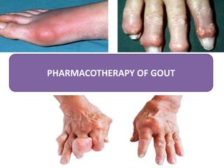 PHARMACOTHERAPY OF GOUT
 