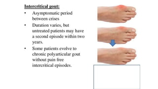 Gout | PPT