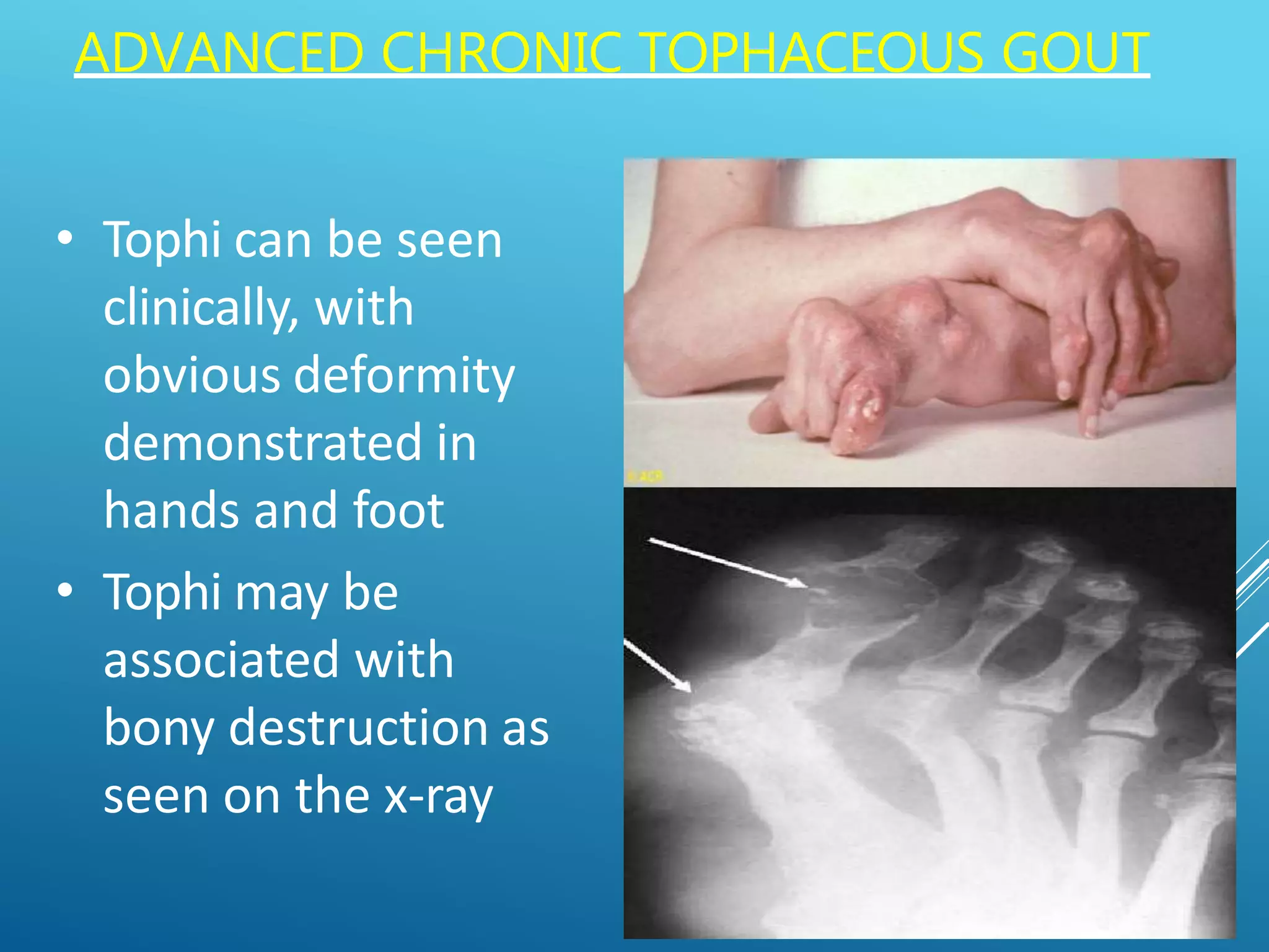 Gout - Clinical features , diagnosis and management | PPTX